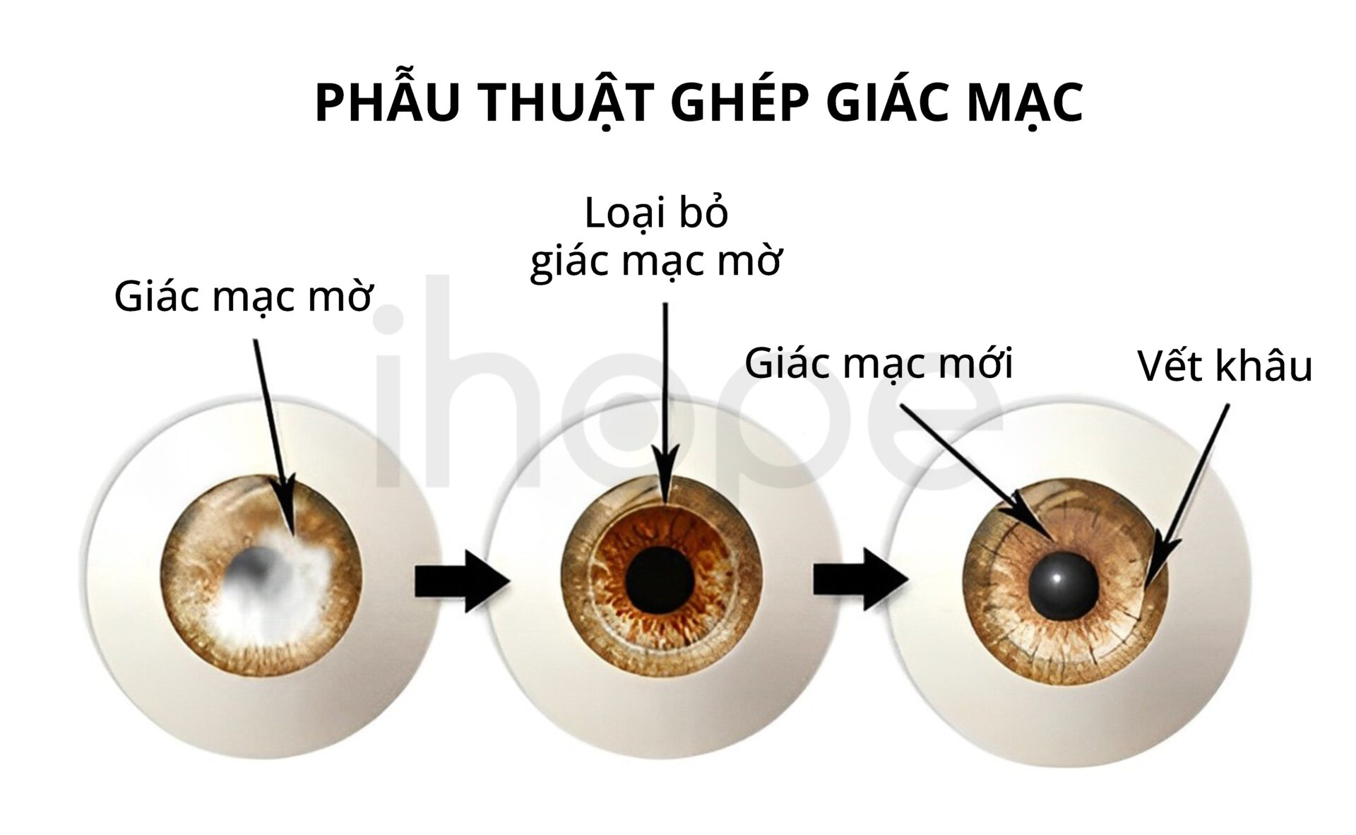 Phẫu Thuật Ghép Giác Mạc (1)