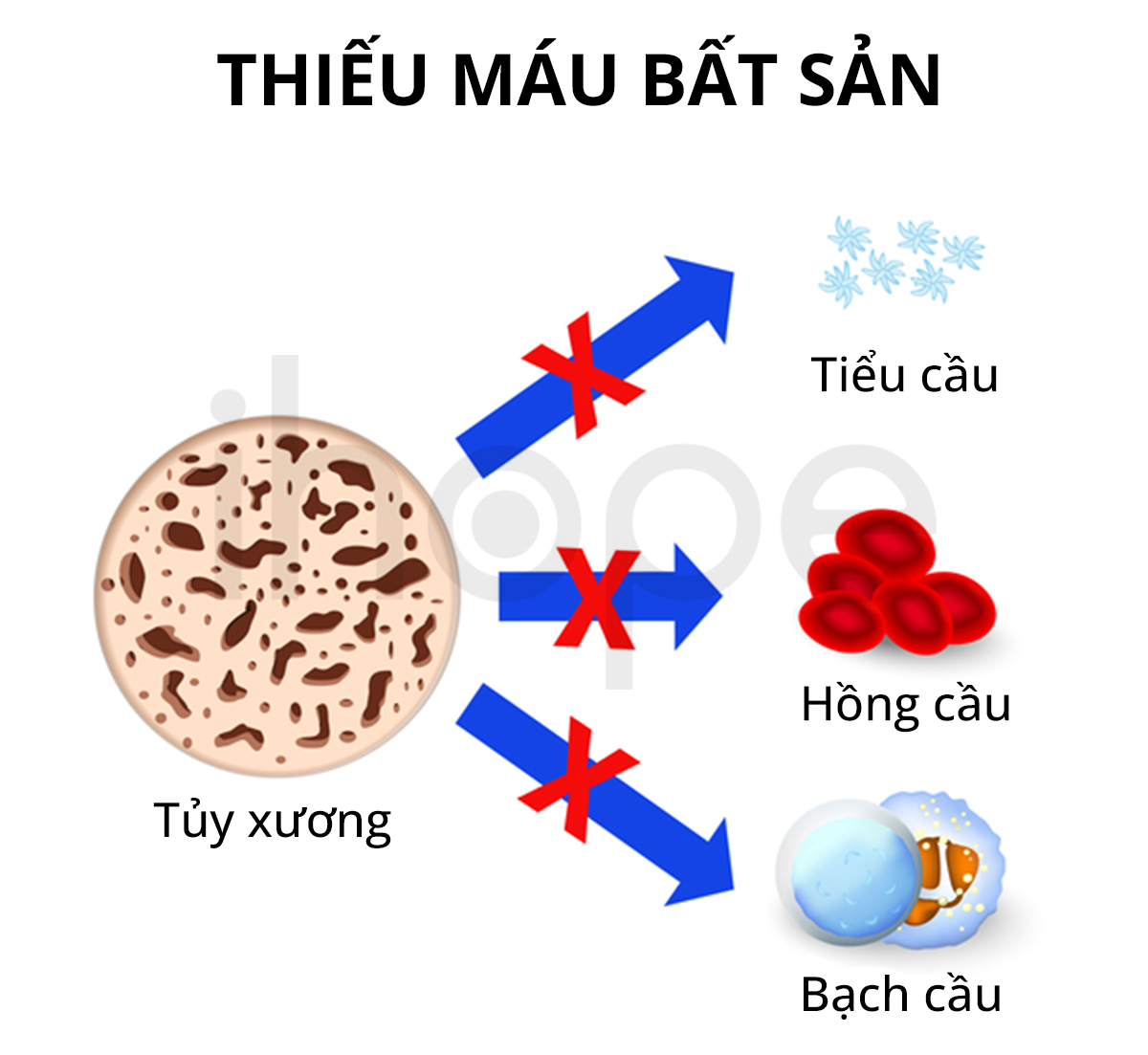 Thiếu Máu Bất Sản