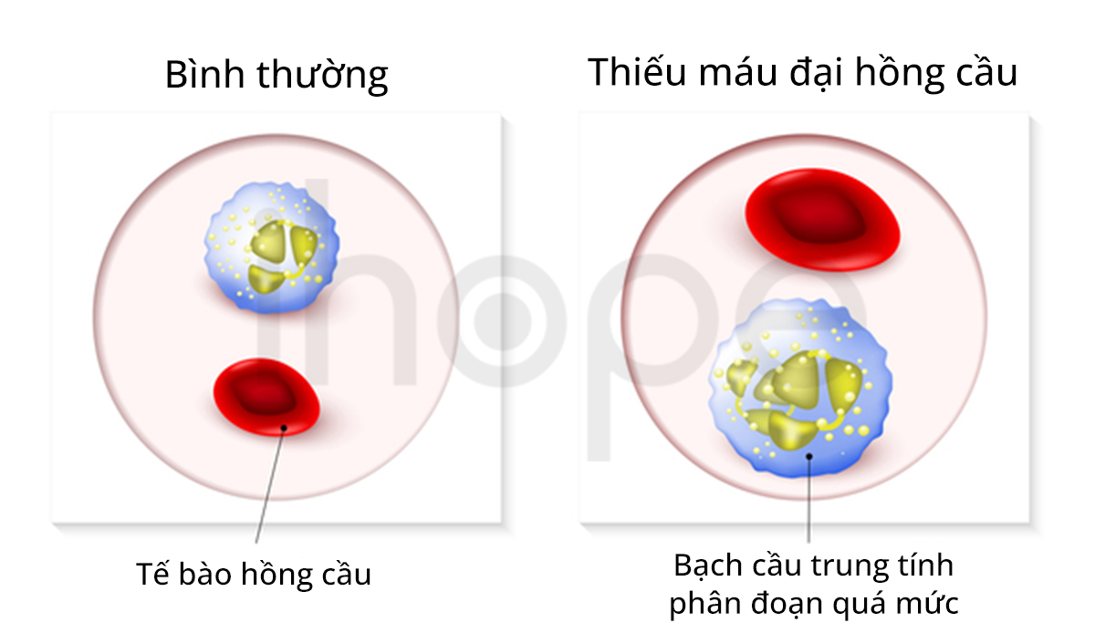 Thiếu Máu đại Hồng Cầu
