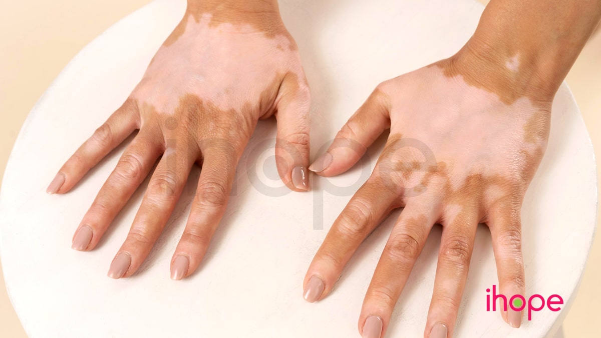 Dày Sừng Lòng Bàn Tay, Bàn Chân Kèm Theo điếc Min