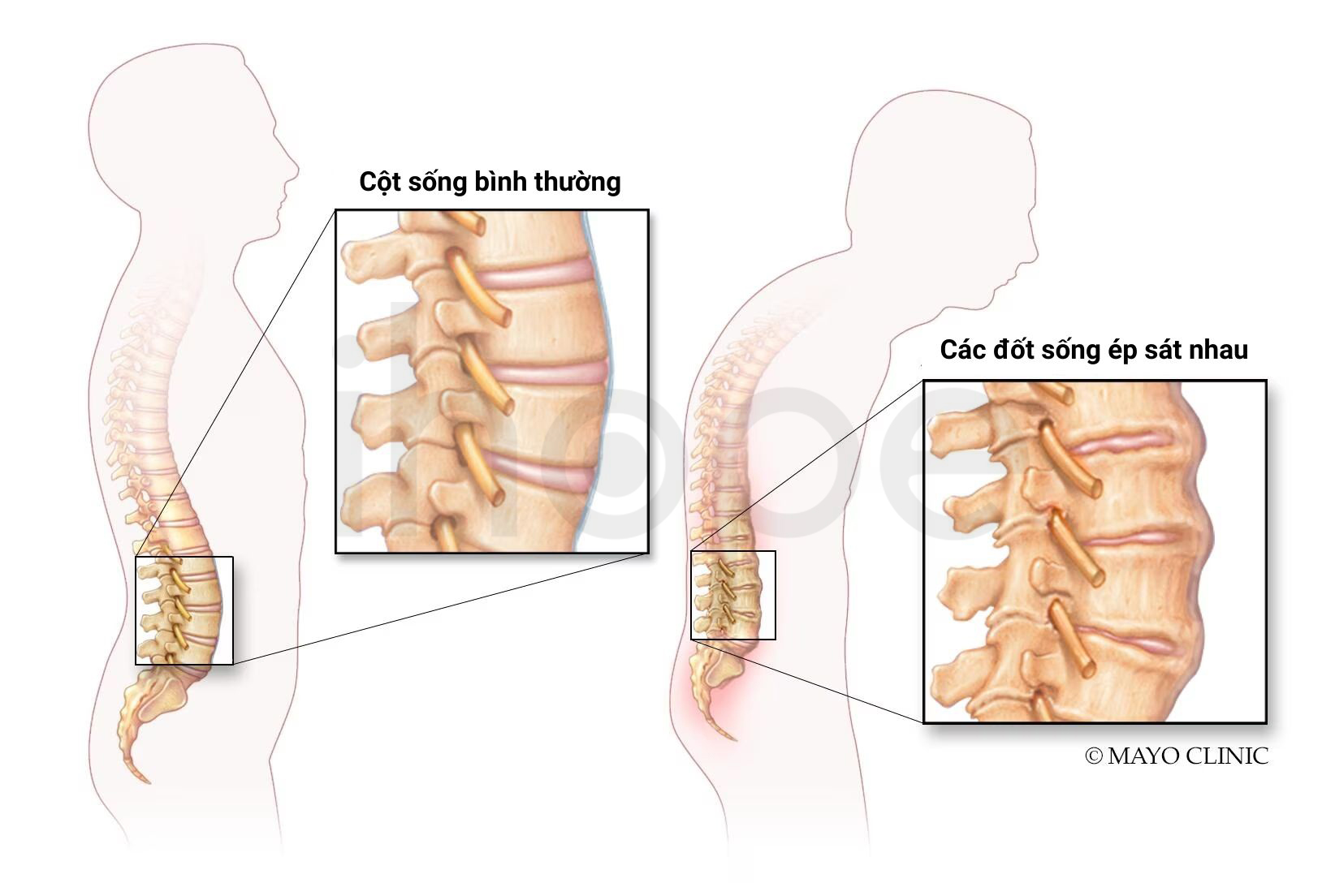 Dính đốt Sống 1