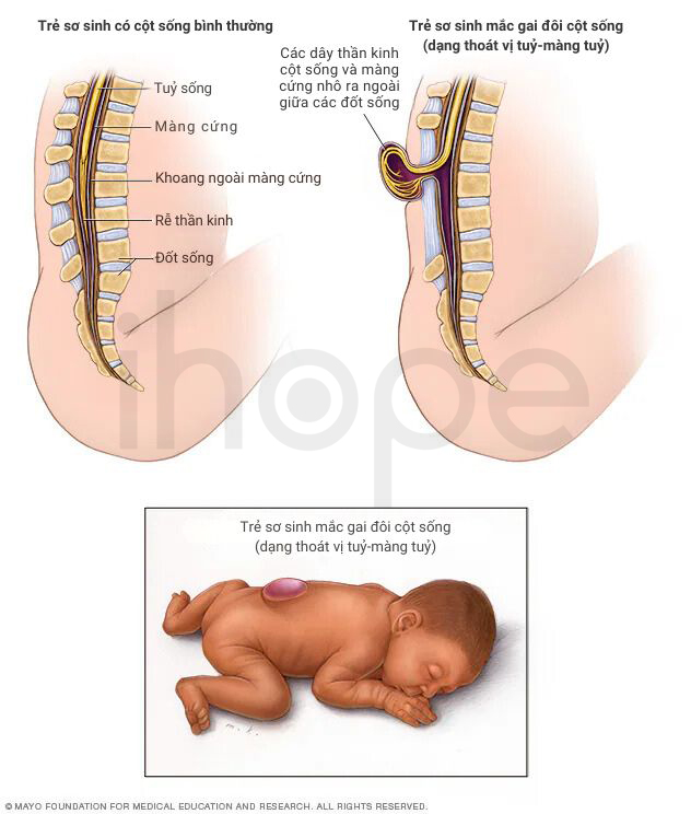 Gai đôi Cột Sống 1