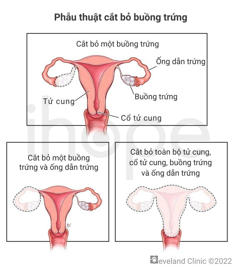 Phẫu Thuật Cắt Bỏ Buồng Trứng