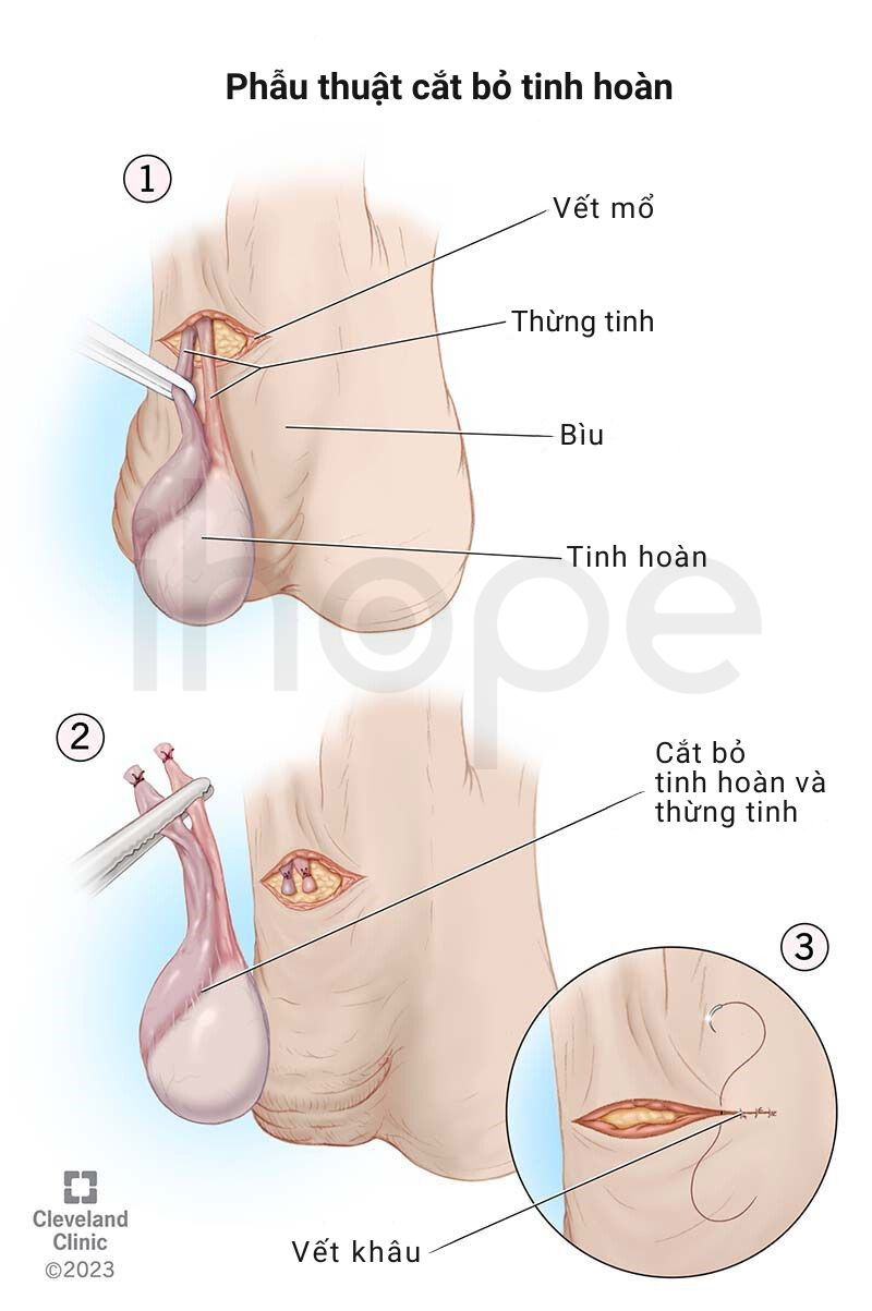 Phẫu Thuật Cắt Bỏ Tinh Hoàn