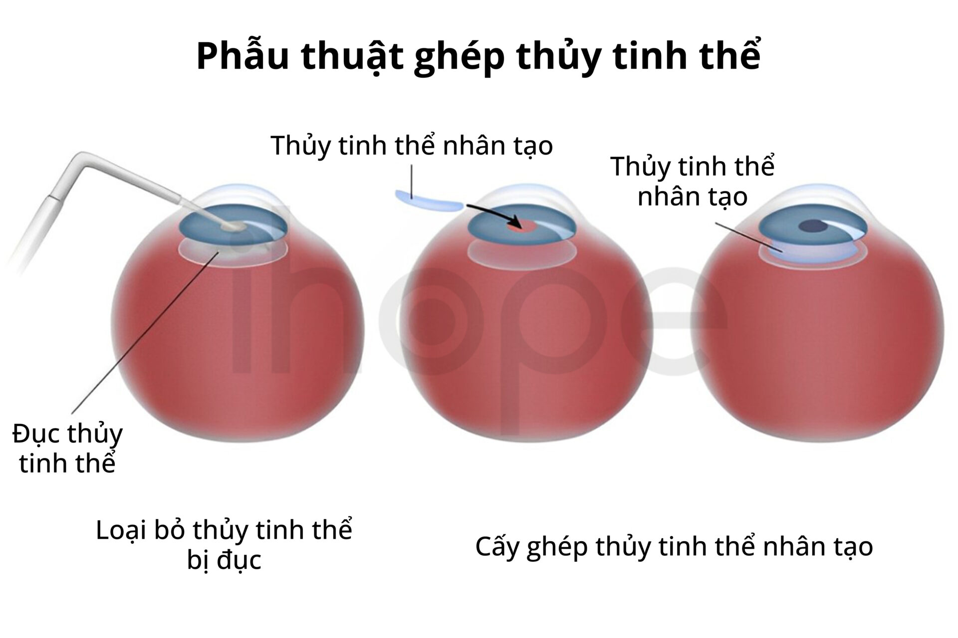 Phẫu Thuật Ghép Thủy Tinh Thể Nhân Tạo