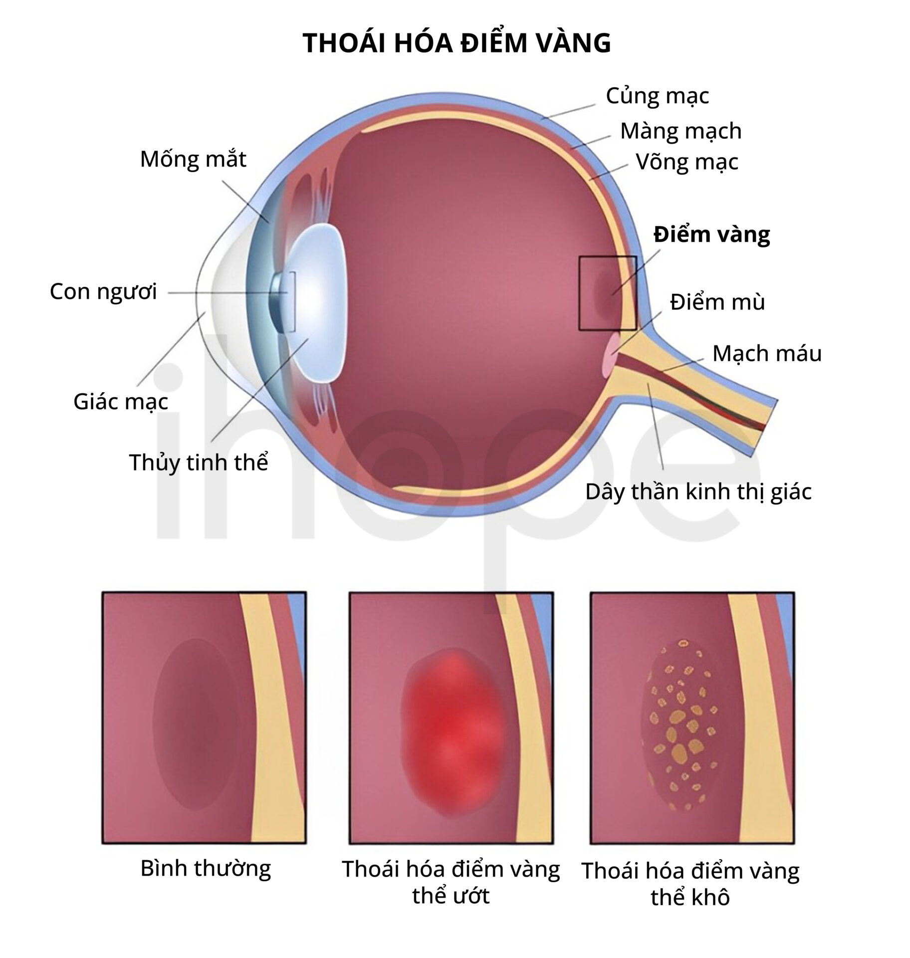 Thoái Hóa điểm Vàng