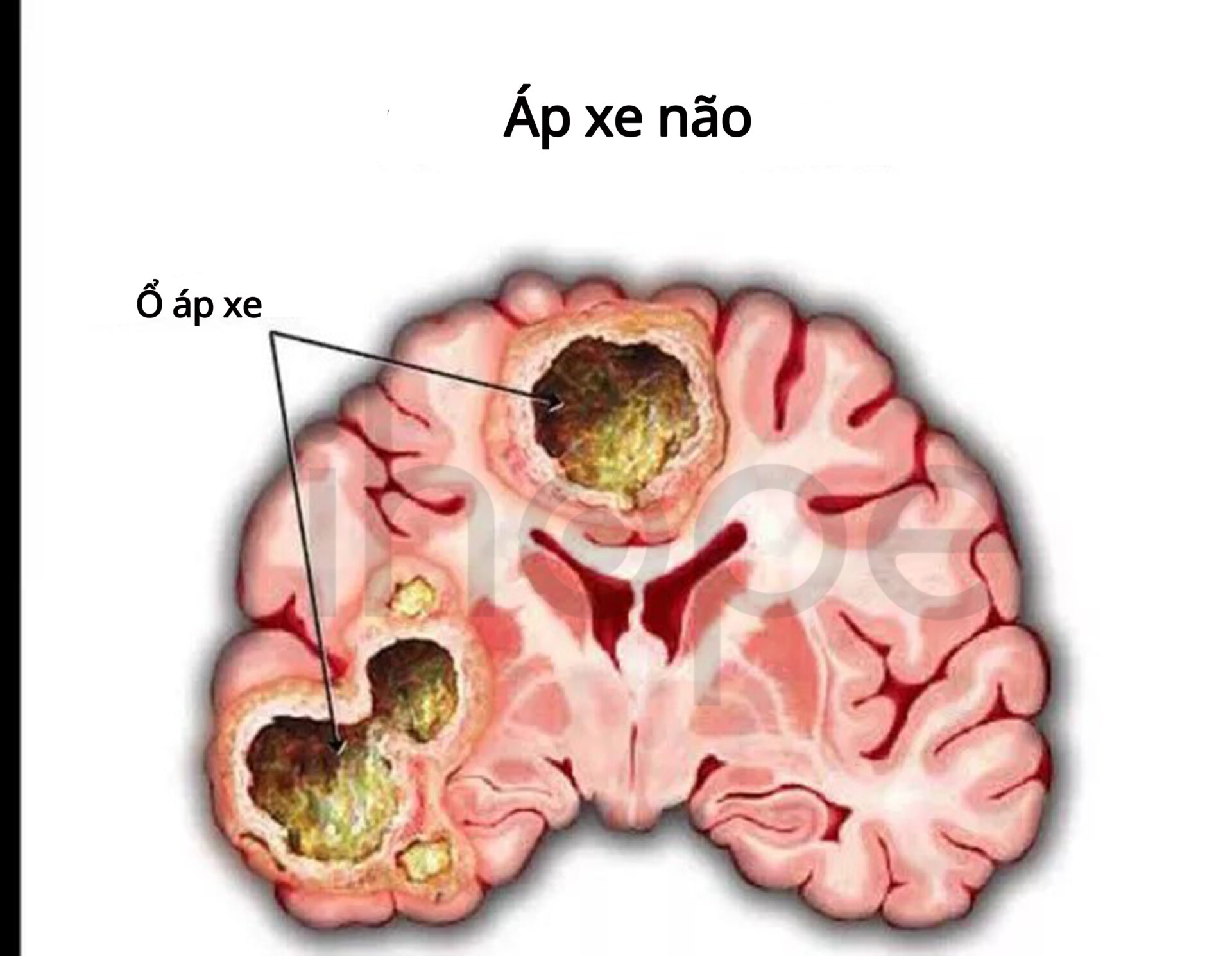 Áp Xe Não