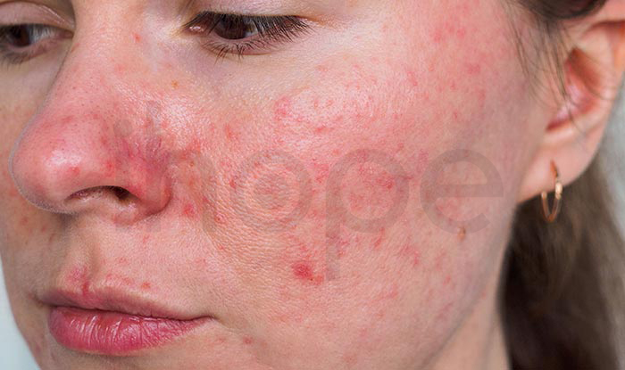 Bệnh Trứng Cá đỏ ảnh Hưởng đến Thẩm Mỹ