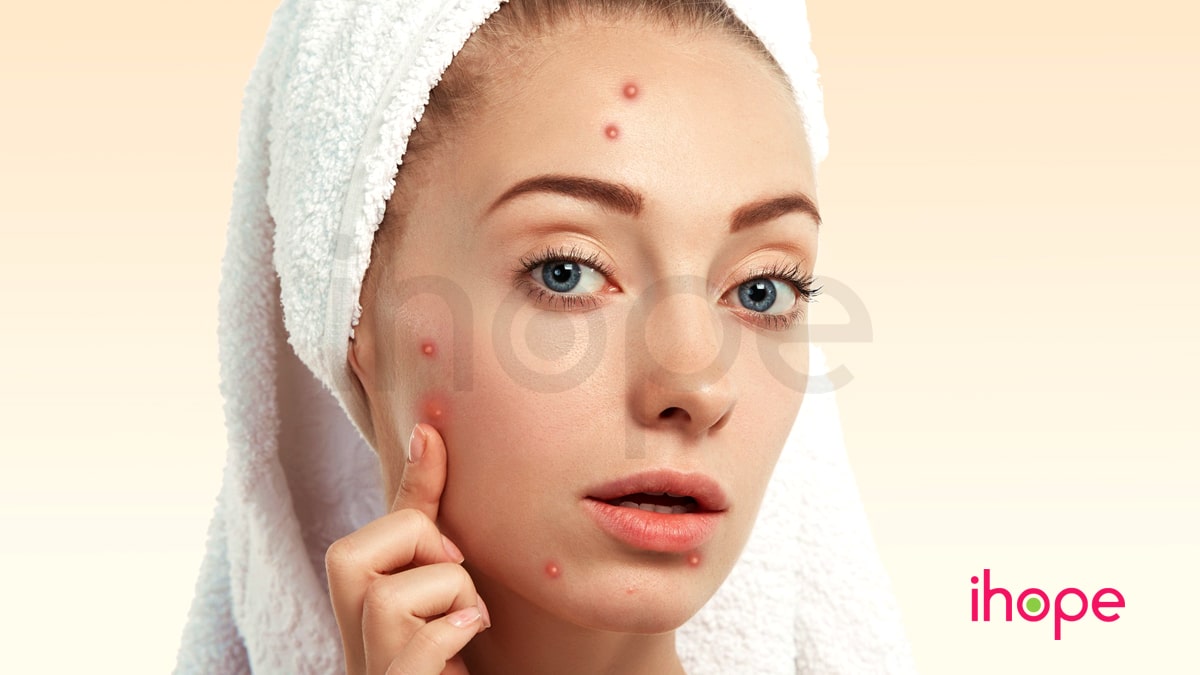 Bệnh Trứng Cá đỏ Min