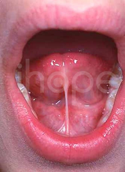 Dính Dây Thắng Lưỡi