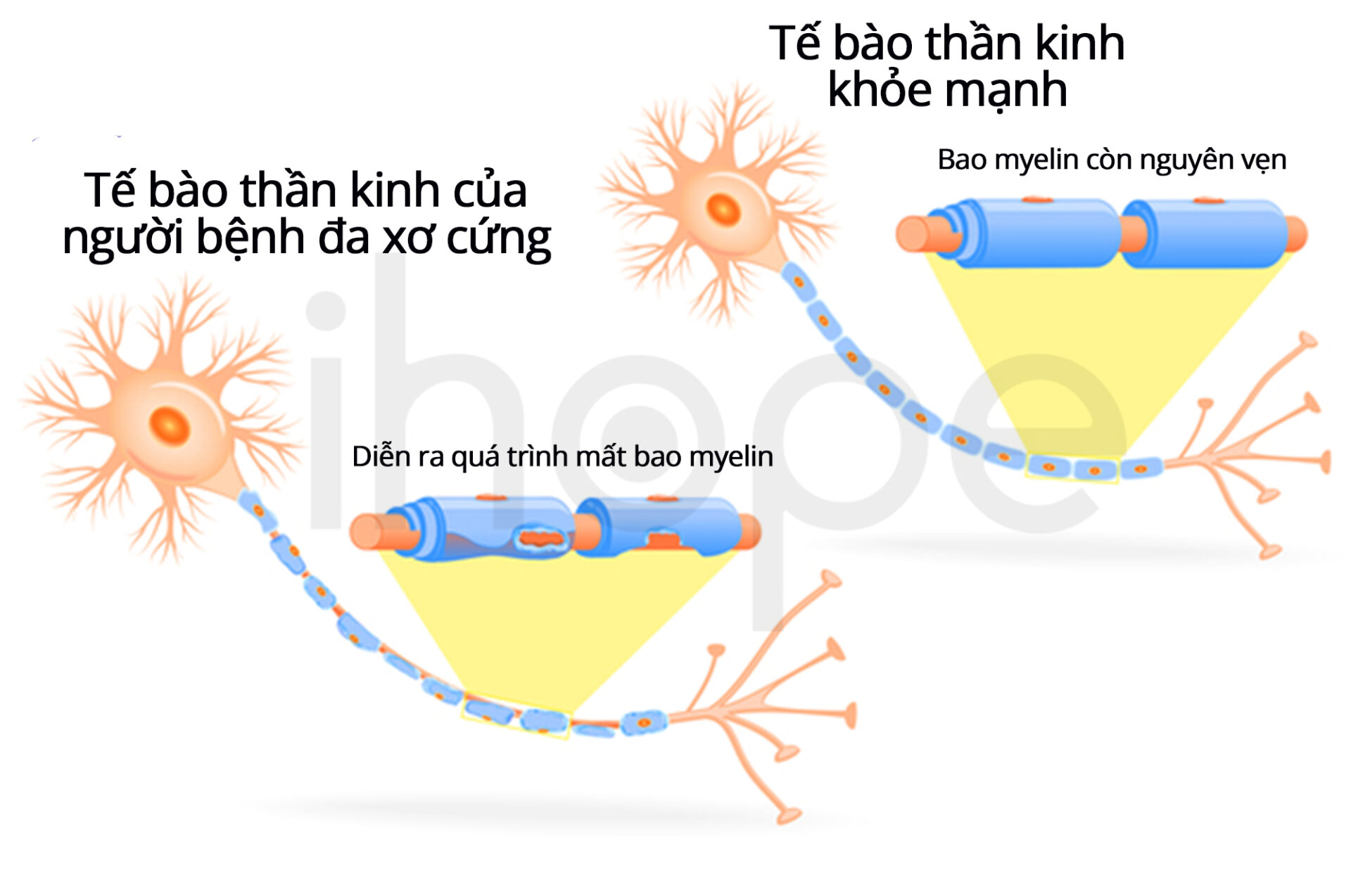 Tế Bào Thần Kinh Của Người Bệnh đa Xơ Cứng