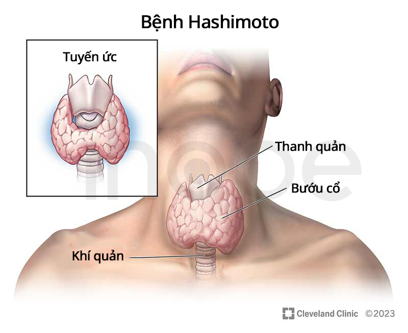 Bệnh Hashimoto