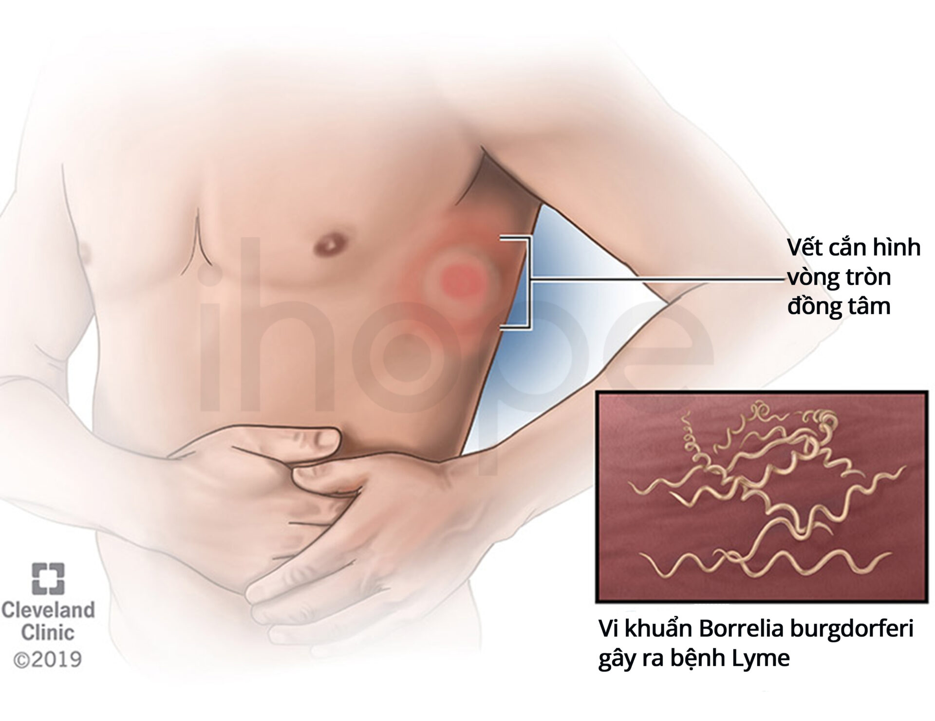 Bệnh Lyme