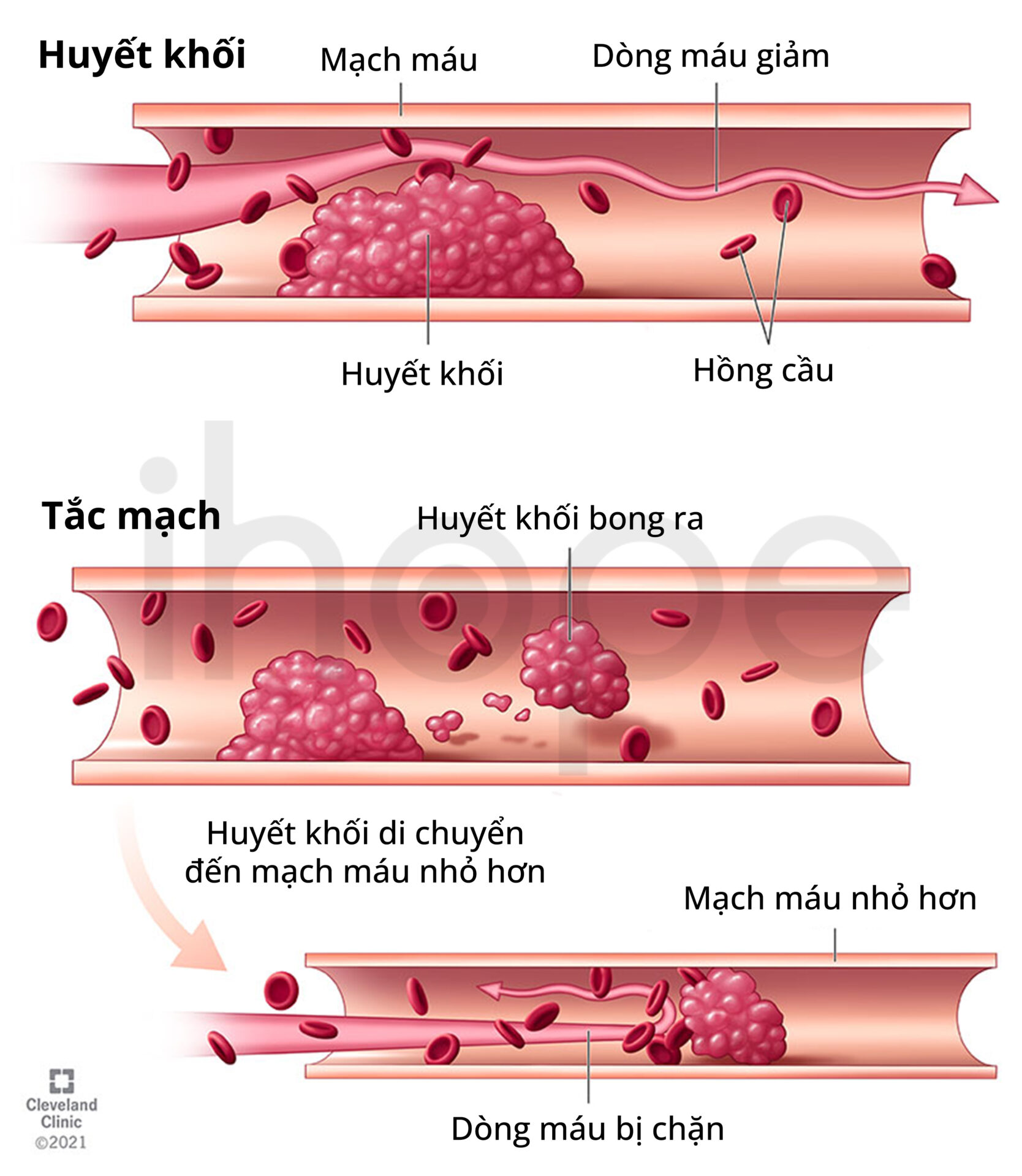 Cục Máu đông Gây Tắc Nghẽn Mạch Máu