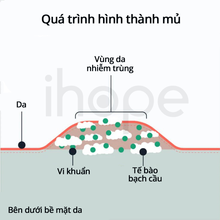 Hình Thành Mủ