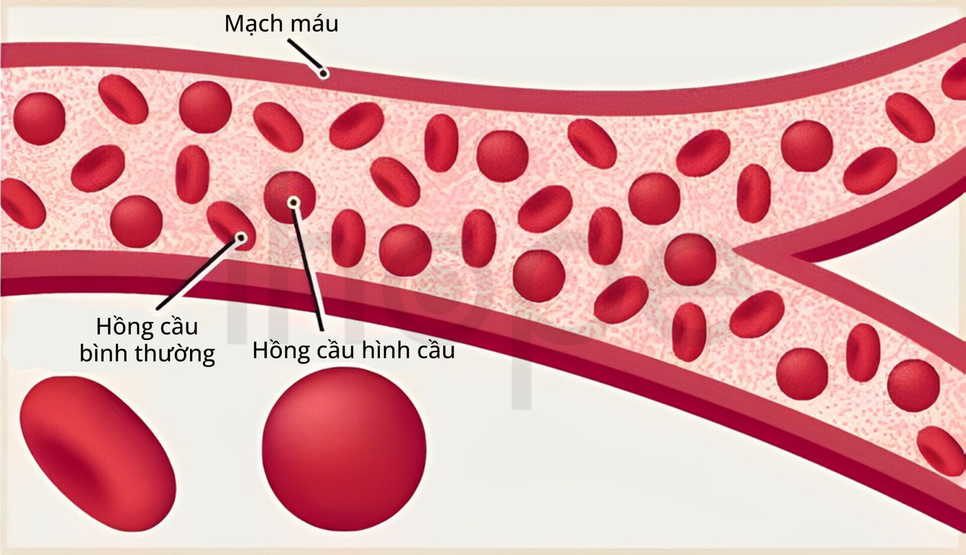 Hồng Cầu Hình Cầu