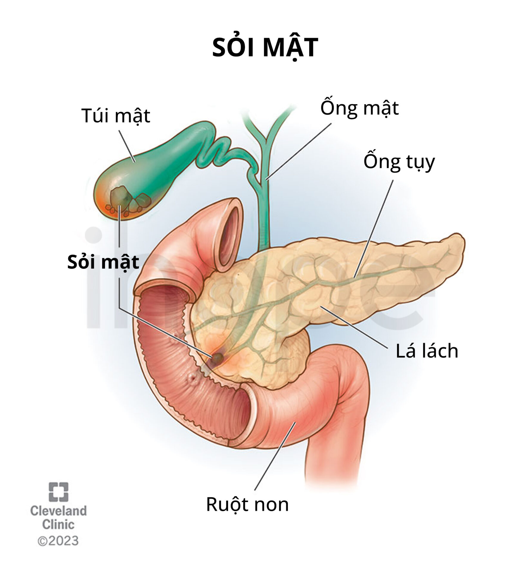 Sỏi Mật