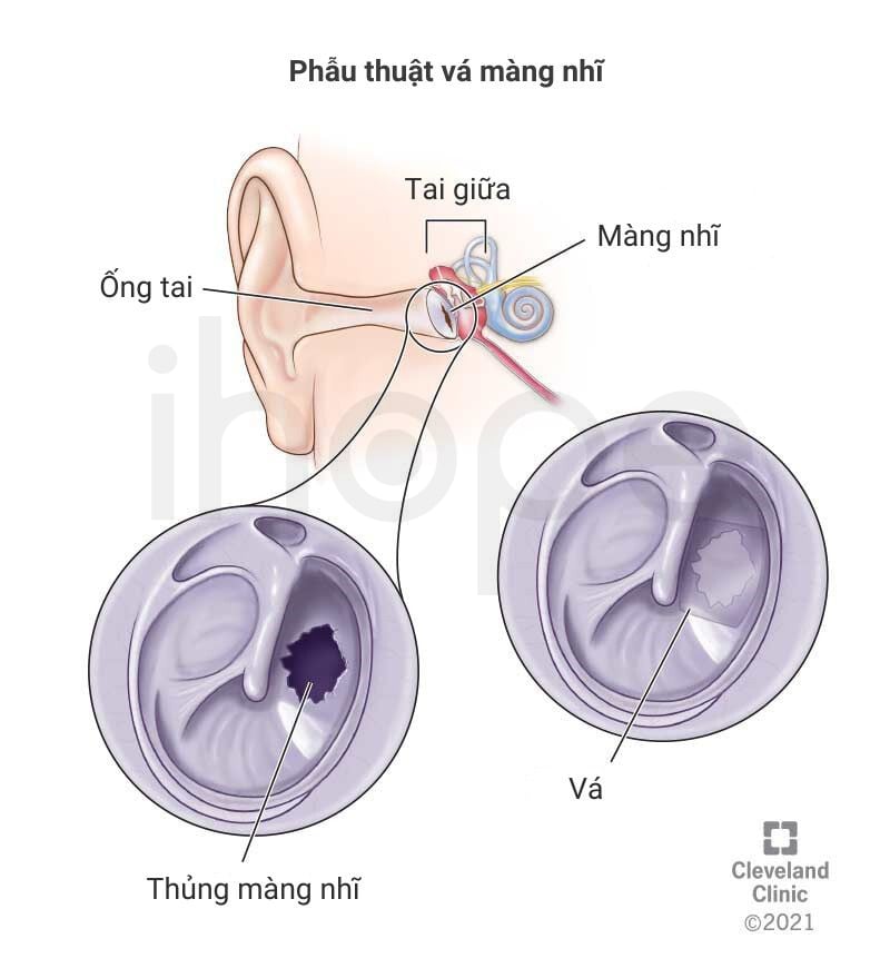 Phẫu Thuật Vá Màng Nhĩ Min