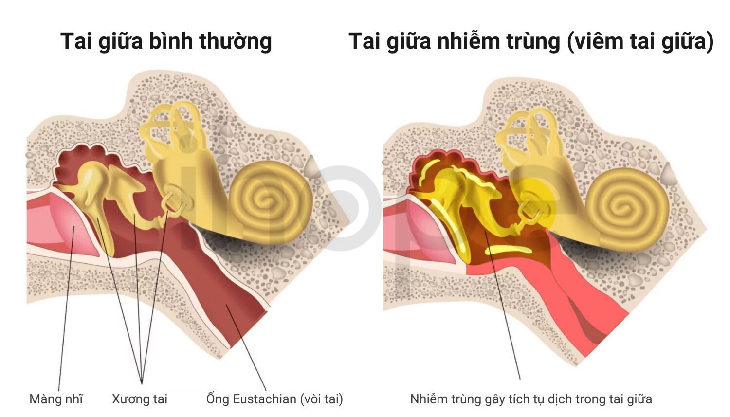 Viêm Tai Giữa