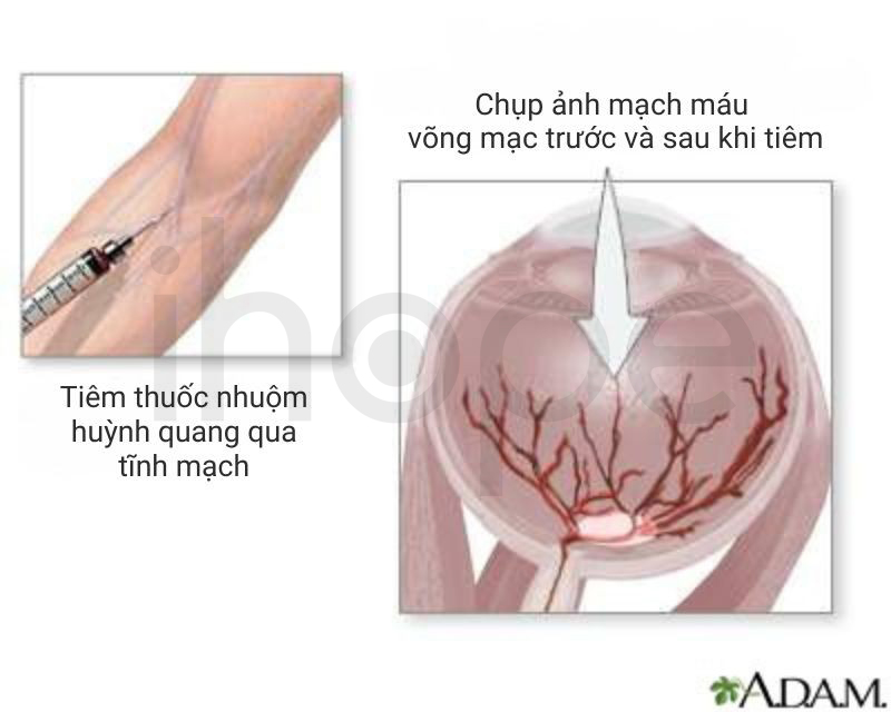 Chụp Huỳnh Quang Màng Mạch