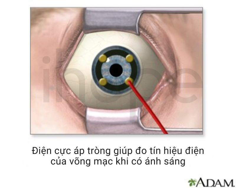 Điện Cơ Mắt