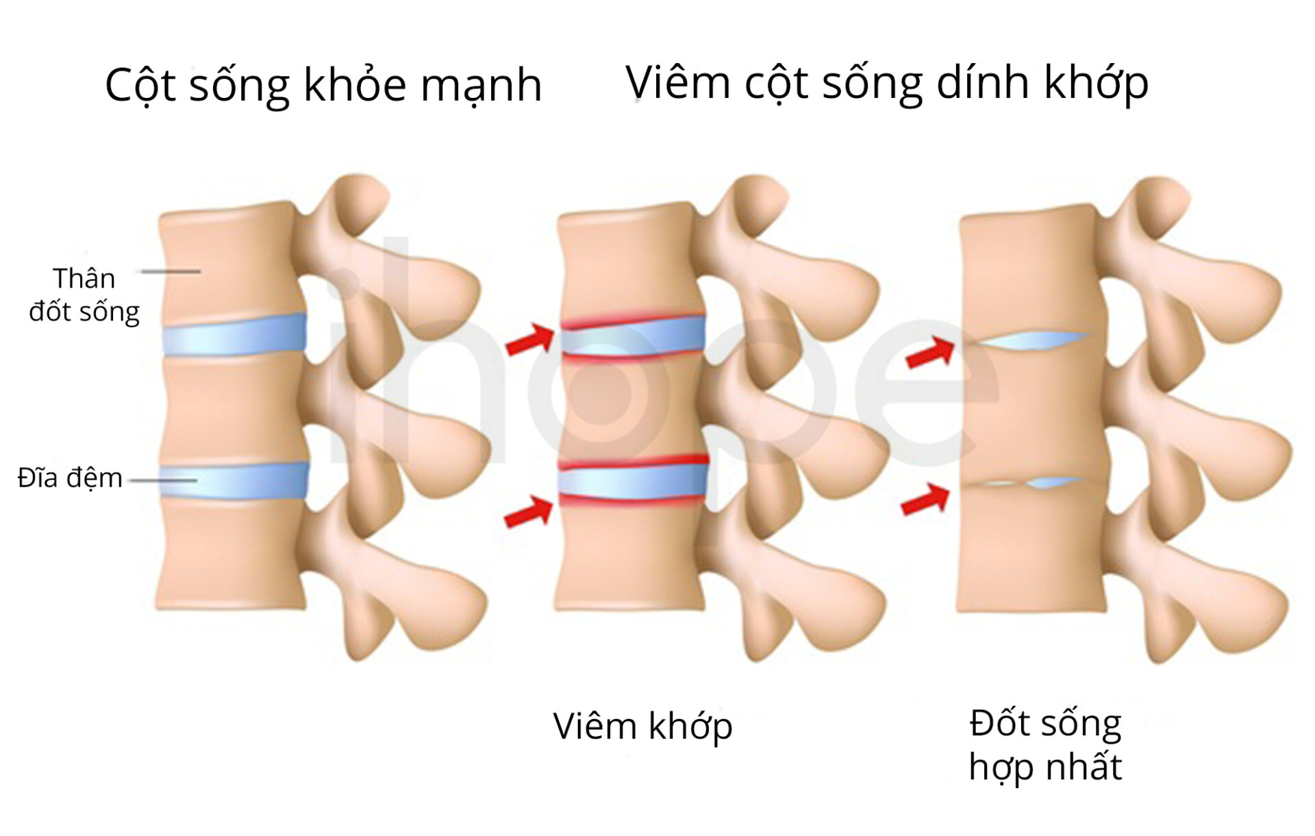 Viêm Cột Sống Dinh Khớp