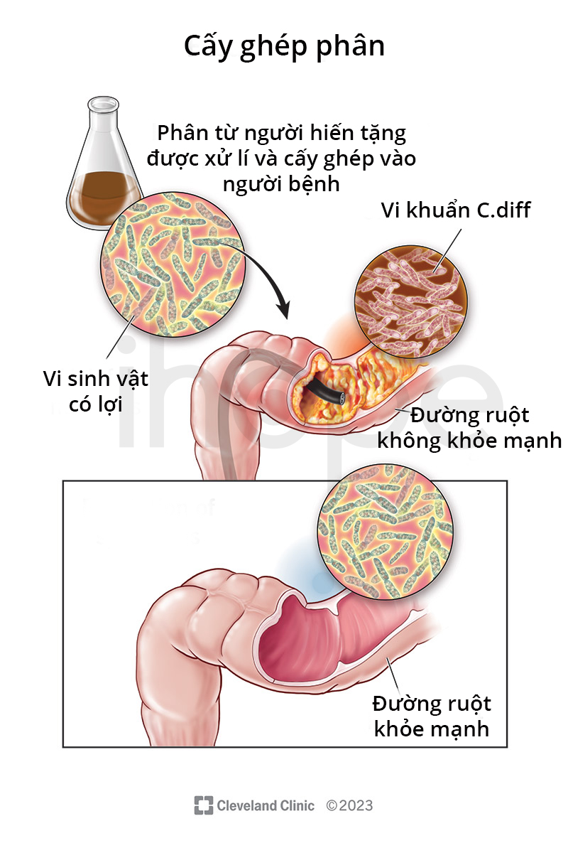 Cấy Ghép Phân