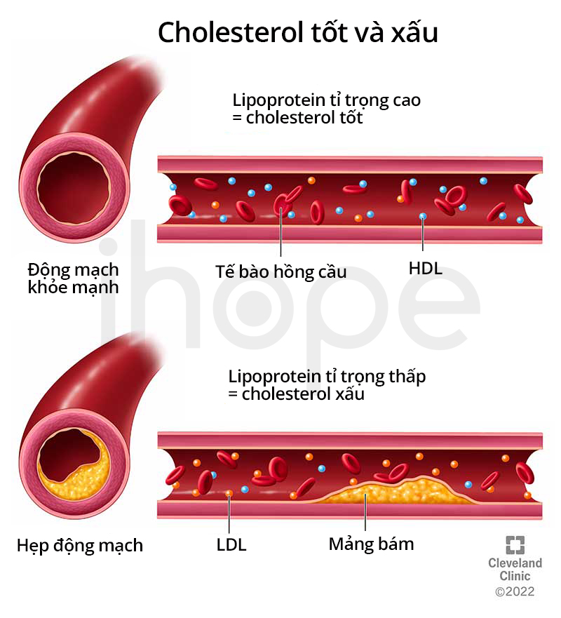Cholesterol Xấu Và Tốt