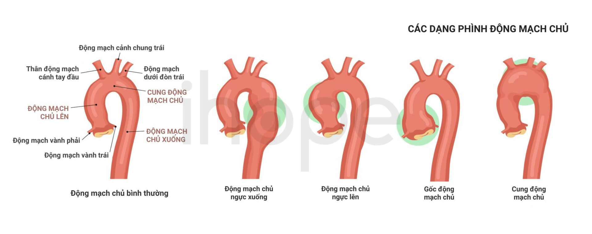 Các dạng phình động mạch chủ