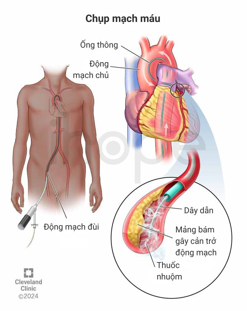 Chụp mạch máu