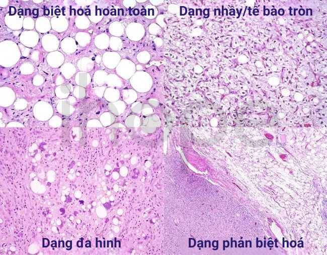 Hình ảnh mô học liposarcoma