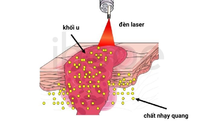 Liệu Pháp Laser