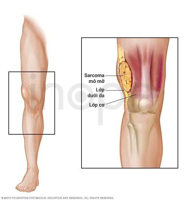 Liposarcoma
