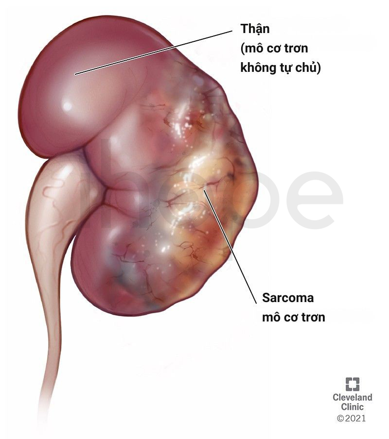 Sarcoma mô cơ trơn