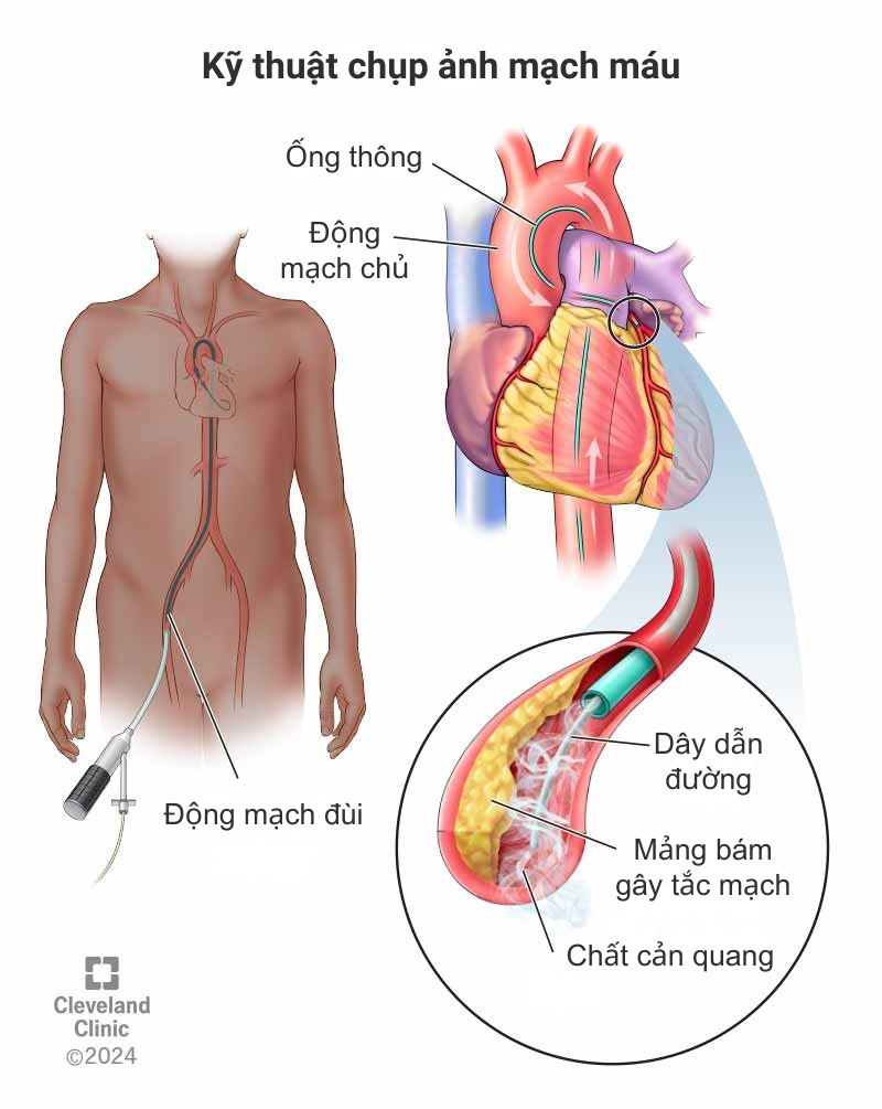 Kĩ thuật chụp ảnh mạch máu