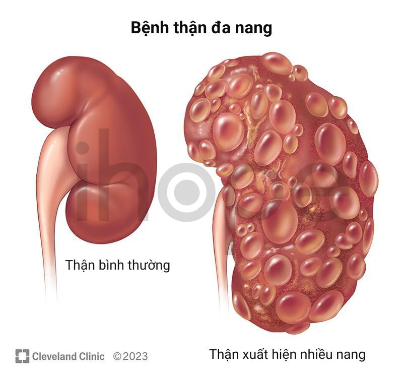Thận đa nang