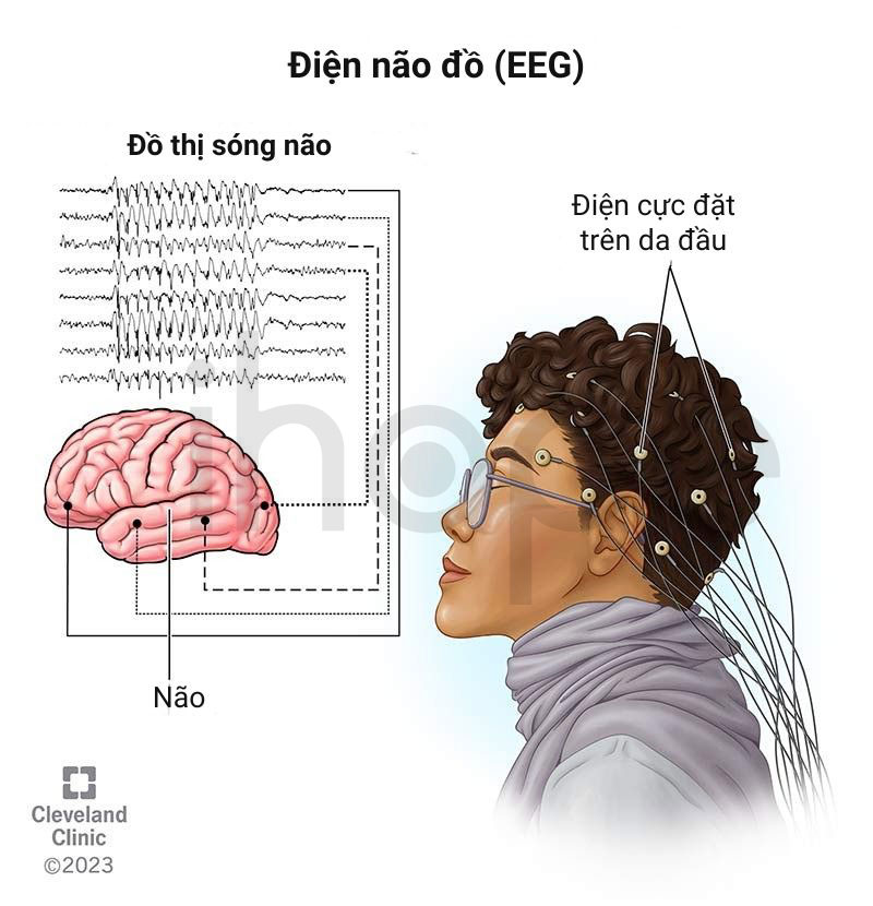 Điện não đồ