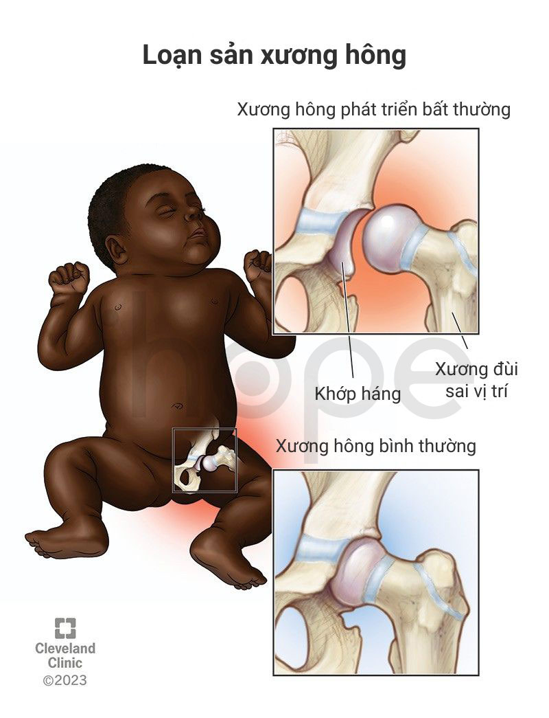 Loạn sản xương hông