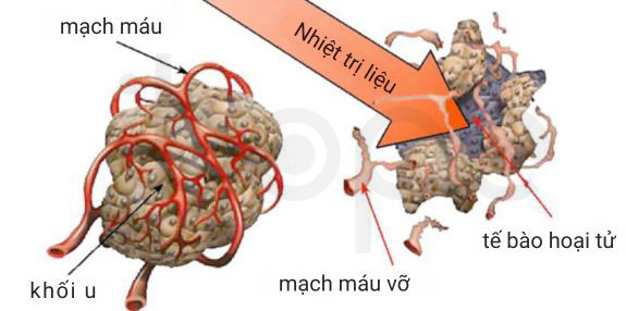 Nhiệt trị liệu
