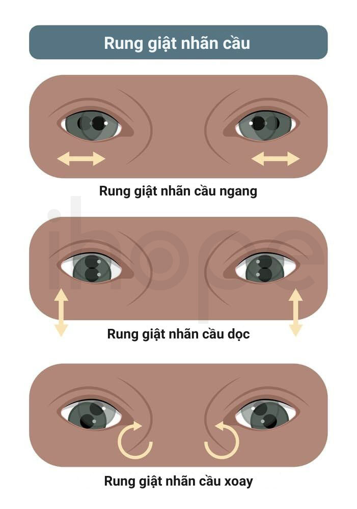 Rung giật nhãn cầu