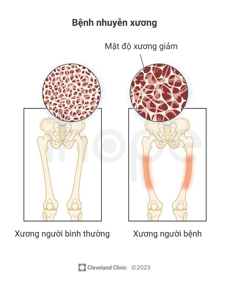 Bệnh nhuyễn xương