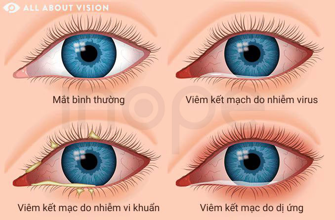 Các dạng viêm kết mạc