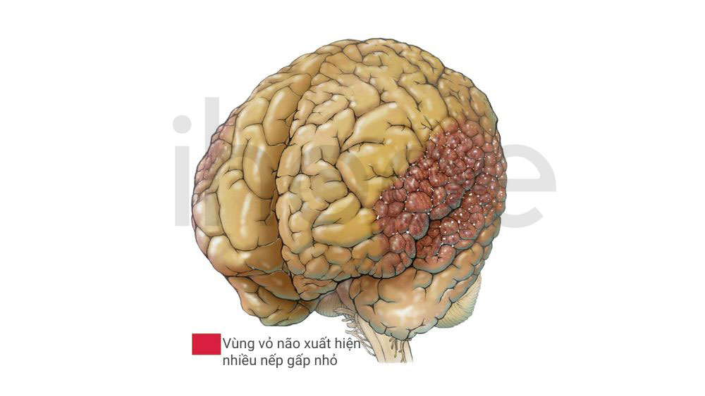 Dị dạng hồi não