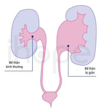 Giãn bể thận