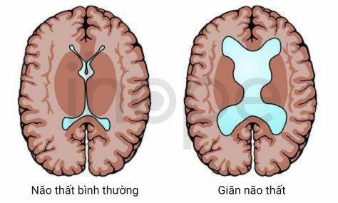 Giãn não thất