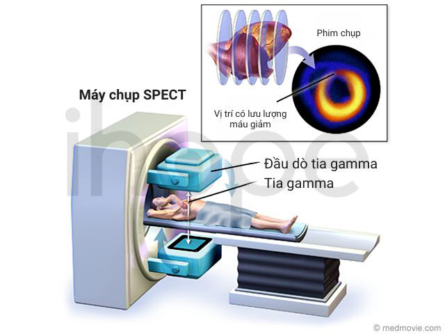 Máy chụp spect