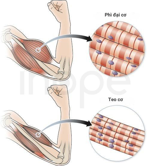 Phì đại cơ và teo cơ