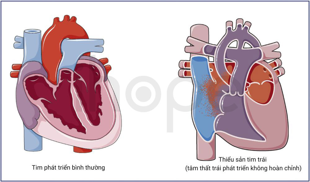 Thiểu sản tim