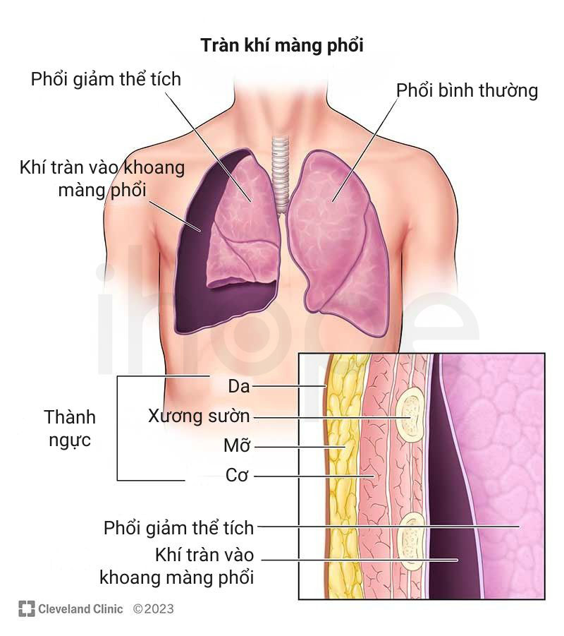 Tràn khí màng phổi