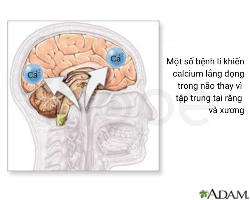 Vôi hoá nội sọ